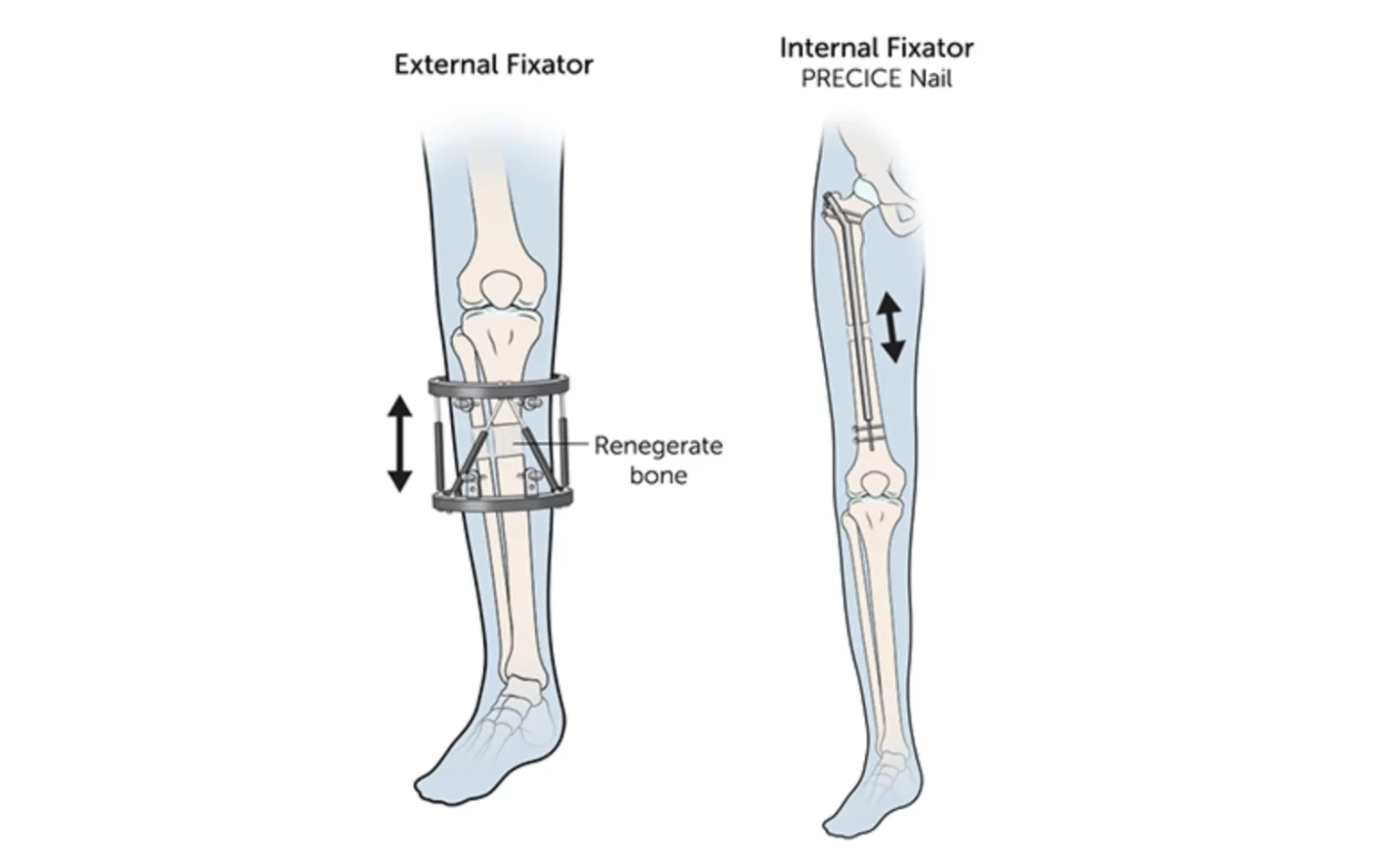 boy uzatma ameliyatı